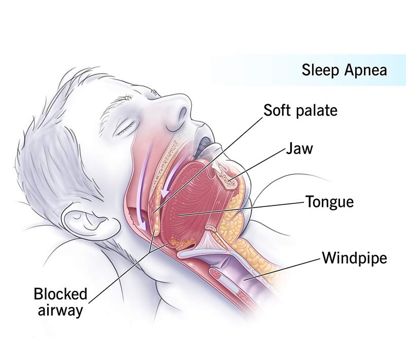 What is Sleep Apnea
