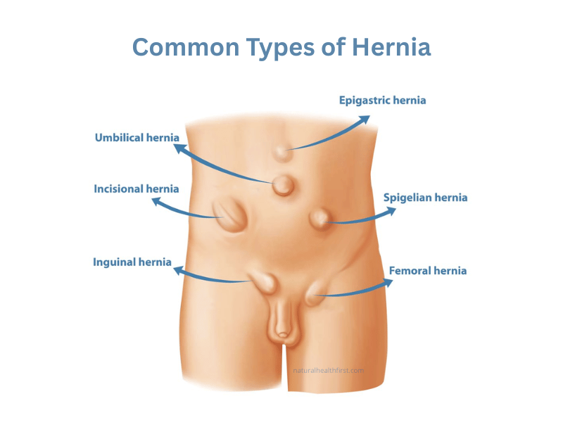 Common Types of Hernia
