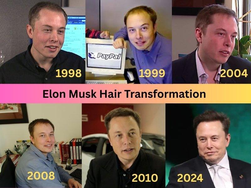 Elon Musk Hair Transplant Before & After Transformation over 20 years