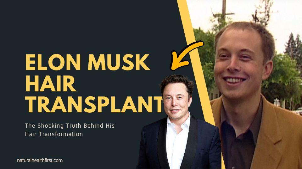 Elon Musk Hair Transplant The Shocking Truth Behind His Hair Transformation