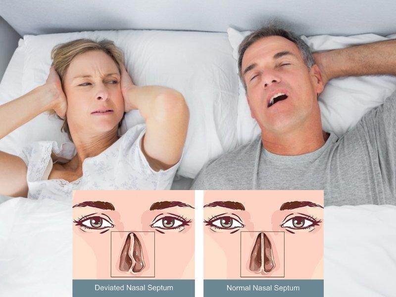 How Does a Deviated Septum Cause Snoring